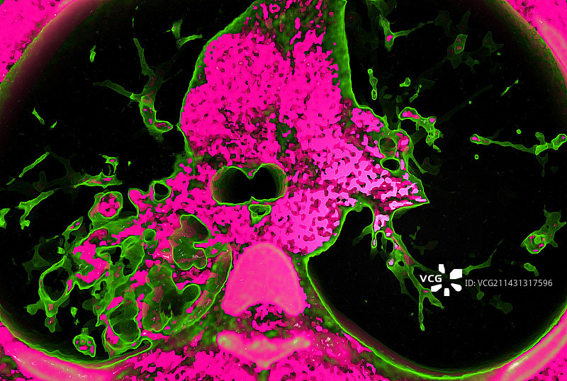 支气管扩张3D CT扫描图片素材