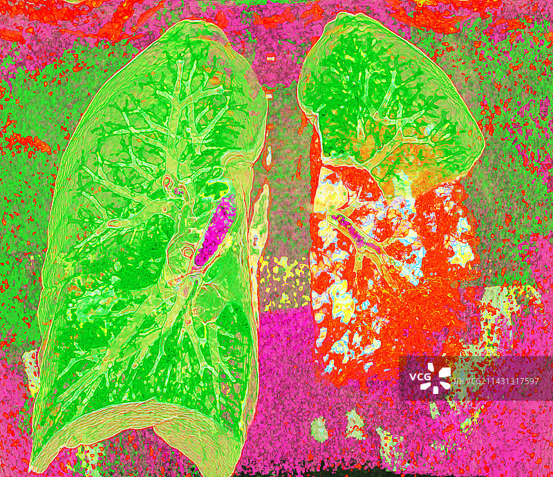 肺炎，CT扫描图片素材