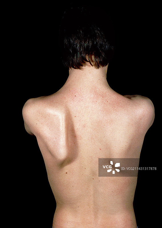 翼状肩胛患者图片素材