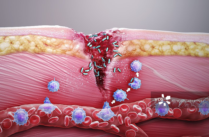 皮肤损伤免疫反应，图示图片素材