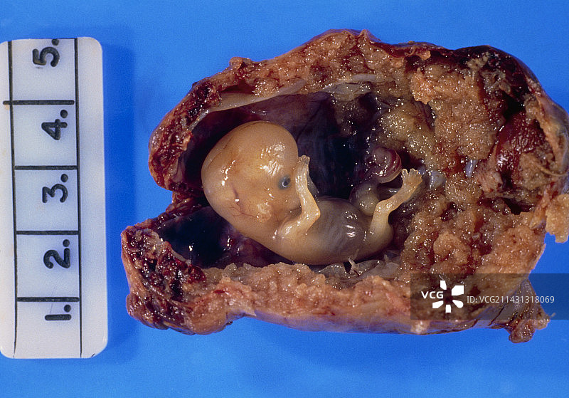输卵管切除与异位妊娠图片素材