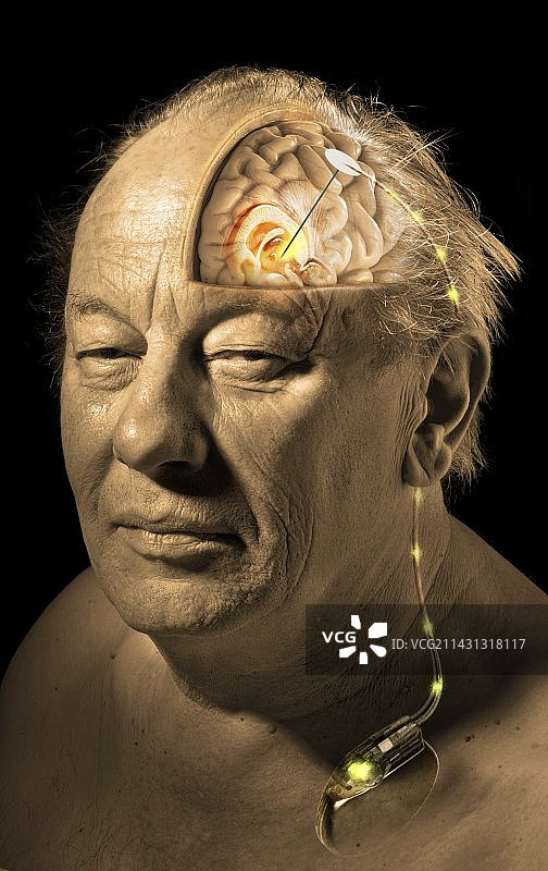 深部脑刺激艺术图图片素材