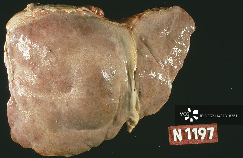 肝硬化图片素材