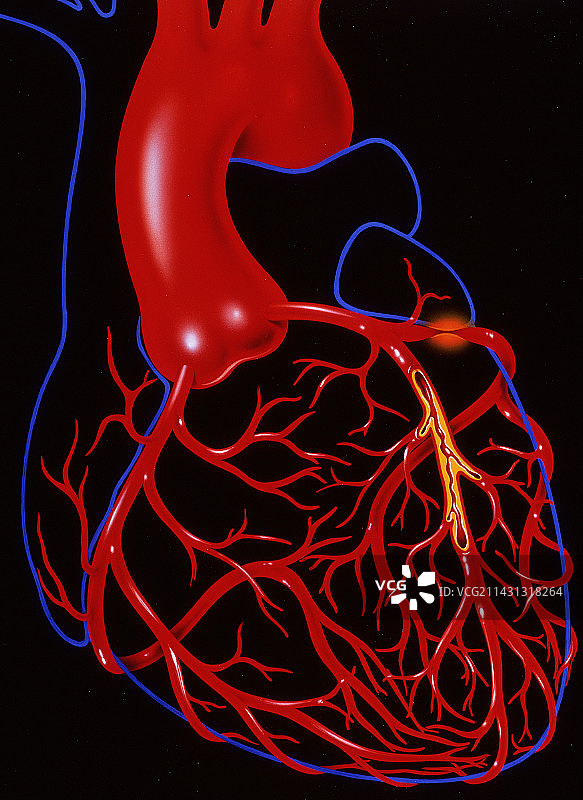 心绞痛图片素材