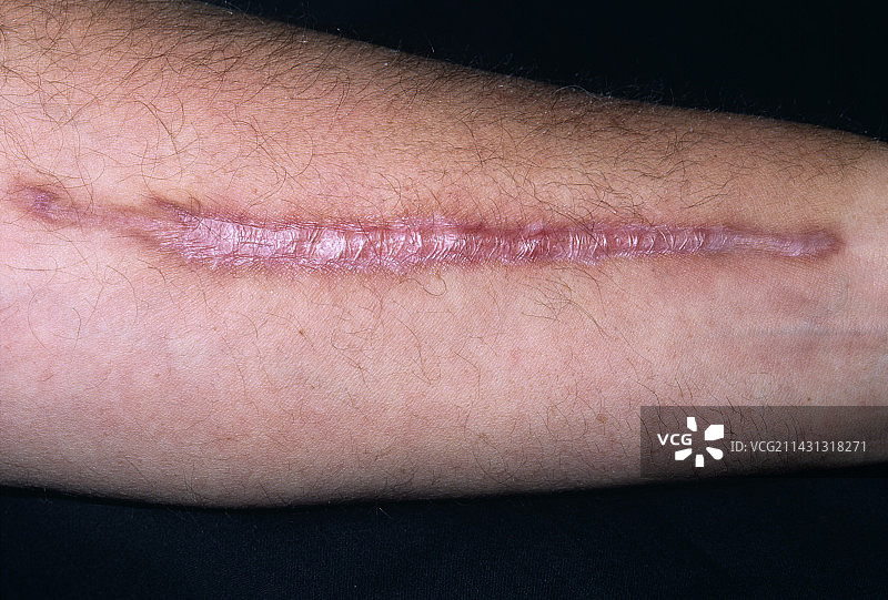 瘢痕疙瘩图片素材