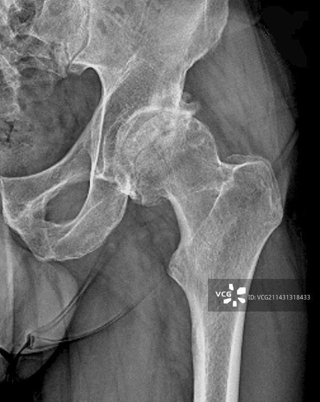 髋部骨坏死X光片图片素材