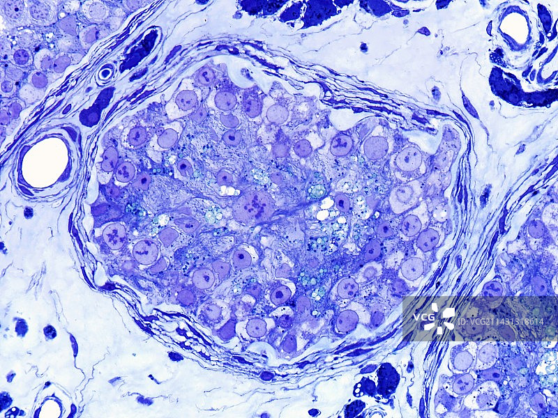 人类睾丸癌，光学显微照片图片素材