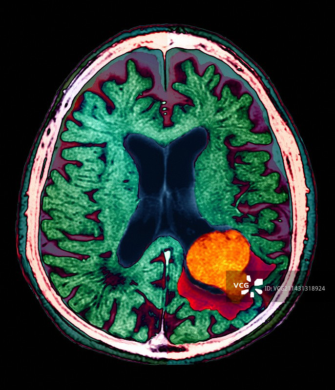 脑损伤核磁共振扫描图片素材