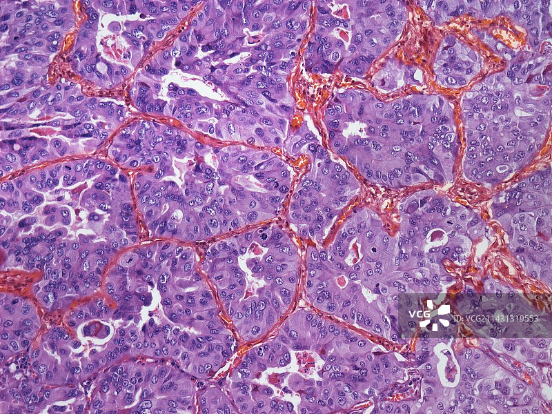 肺癌显微照片图片素材