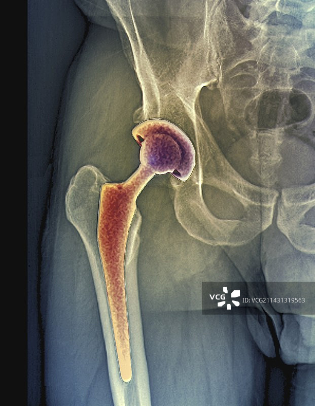 全髋关节置换X光片图片素材