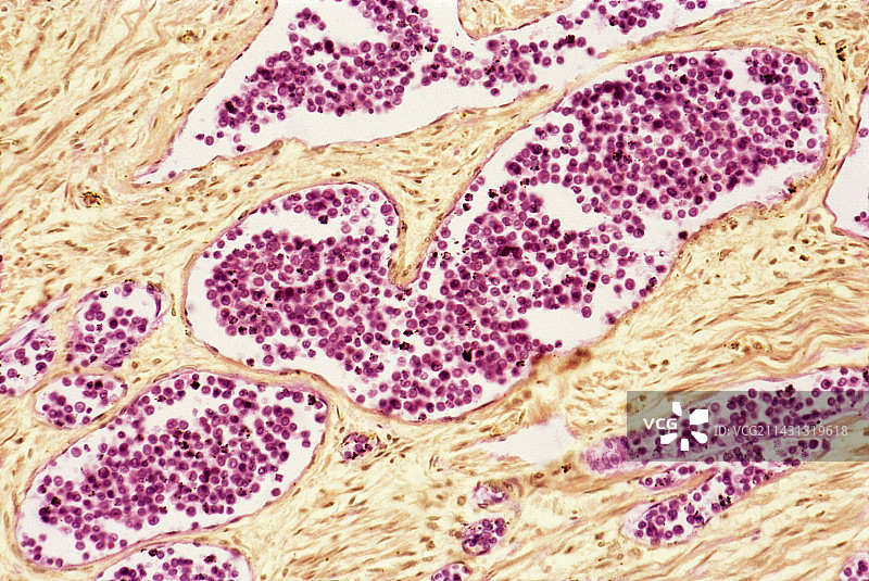 髓系白血病血细胞显微照片图片素材