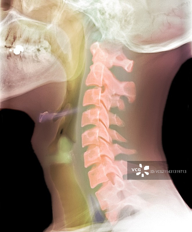 正常颈部X光片图片素材