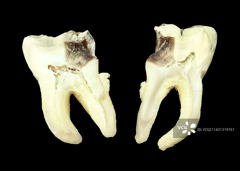 龋齿结构图片素材