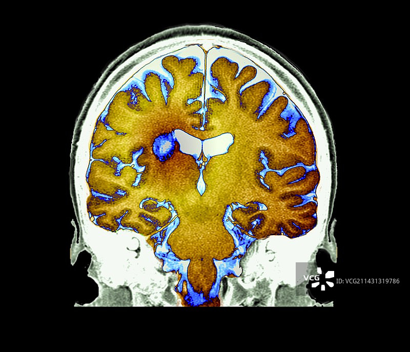多发性硬化症MRI扫描图片素材