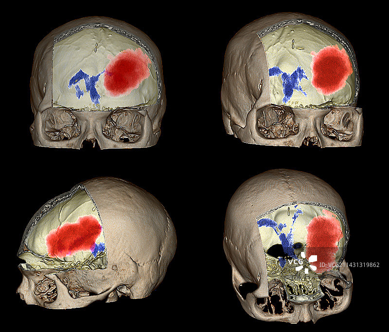 大脑出血CT扫描图片素材