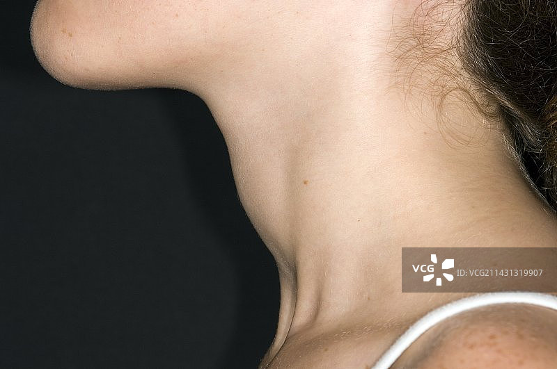 女孩的甲状腺肿图片素材