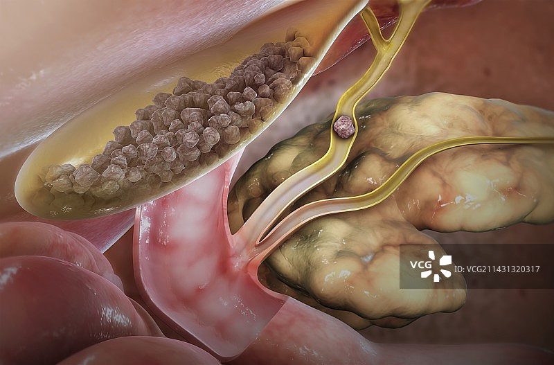 胆囊和胆结石插图图片素材