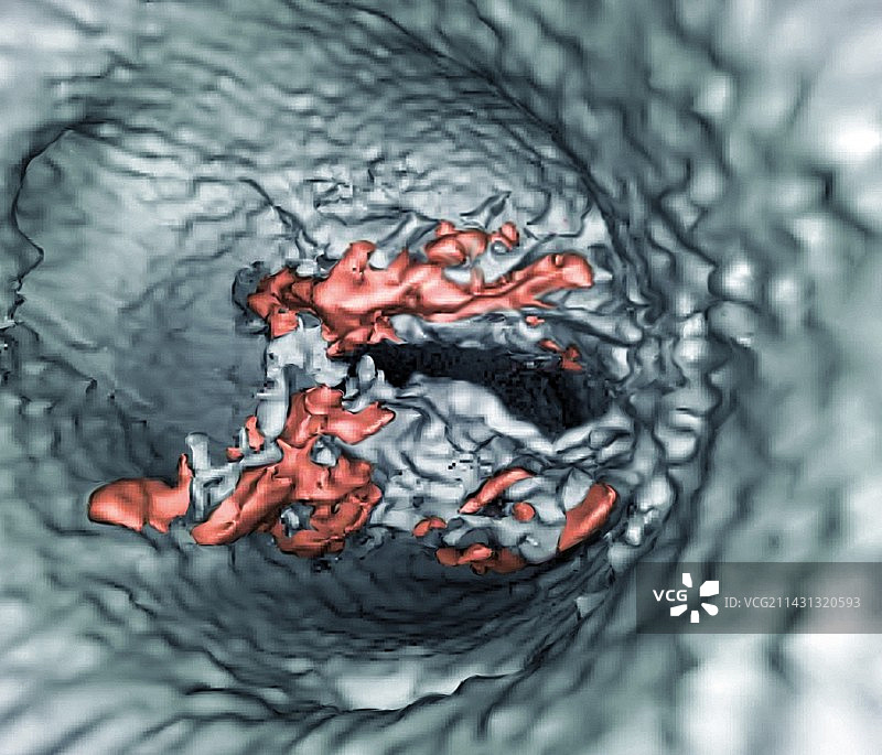 心脏瓣膜疾病3D CT血管造影图片素材