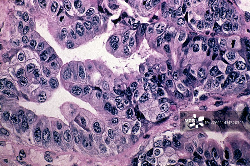 胃癌，光学显微照片图片素材