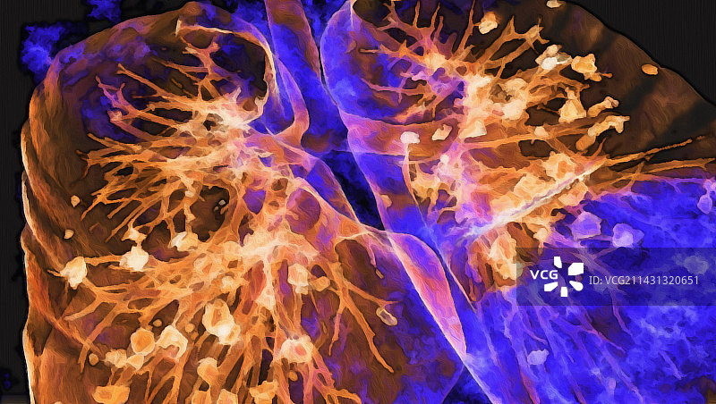 受新冠肺炎影响的肺部3D CT扫描图片素材