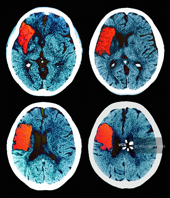 中风，CT扫描图片素材