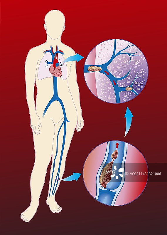 深静脉血栓艺术图图片素材