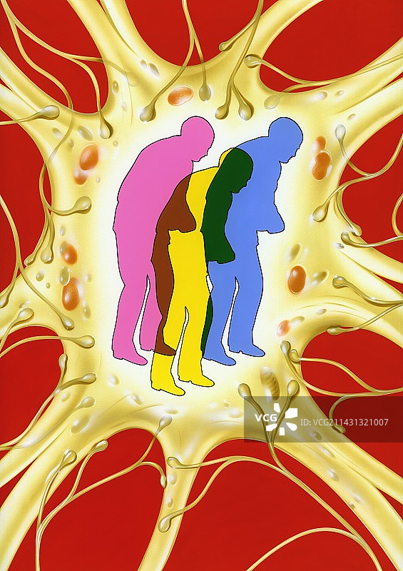 帕金森病图片素材