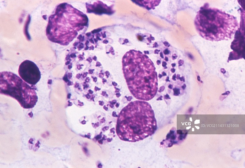 内脏利什曼病图片素材