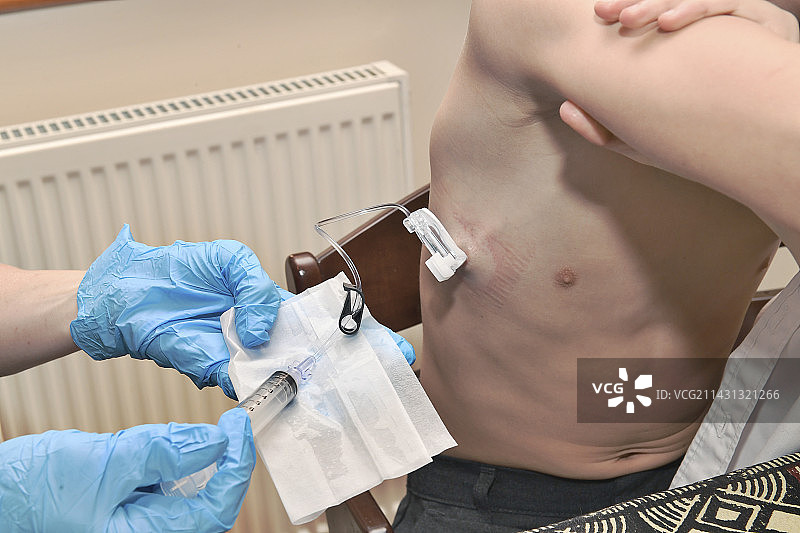 用于血友病药物输送的输液港图片素材