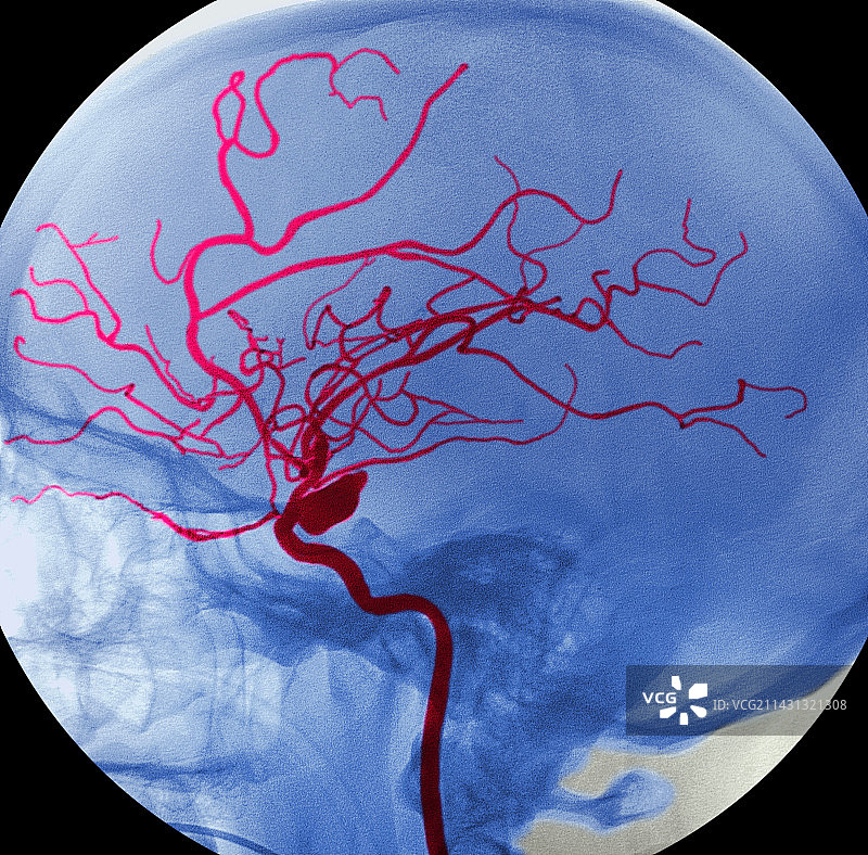 动脉瘤图片素材