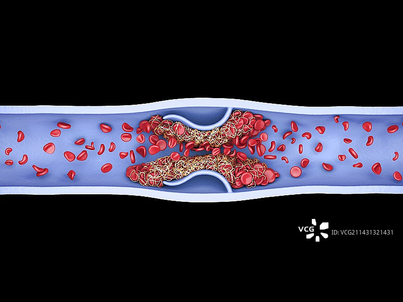 血凝块，插图图片素材
