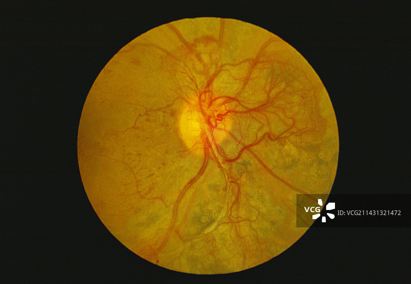 糖尿病引起的视网膜损伤图片素材