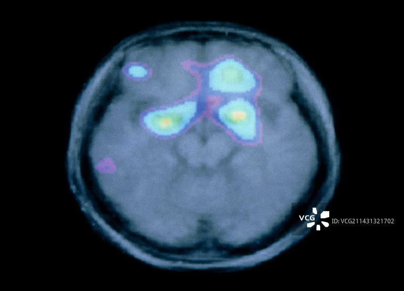 嗅觉活动期间的彩色PET脑部扫描图片素材