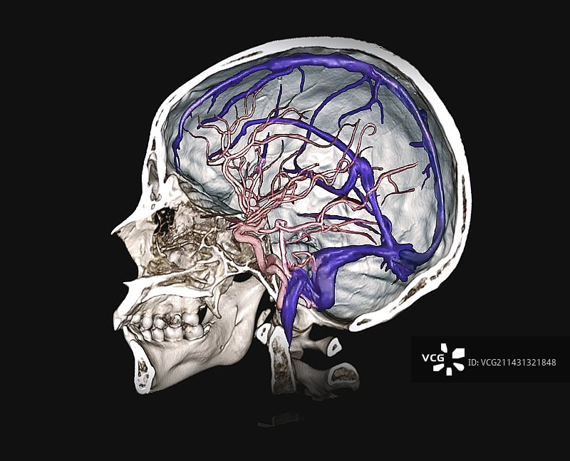 脑动脉和静脉窦3D CT血管造影图片素材
