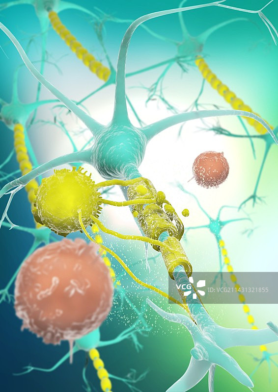 淋巴细胞攻击脑神经胶质细胞，图示图片素材