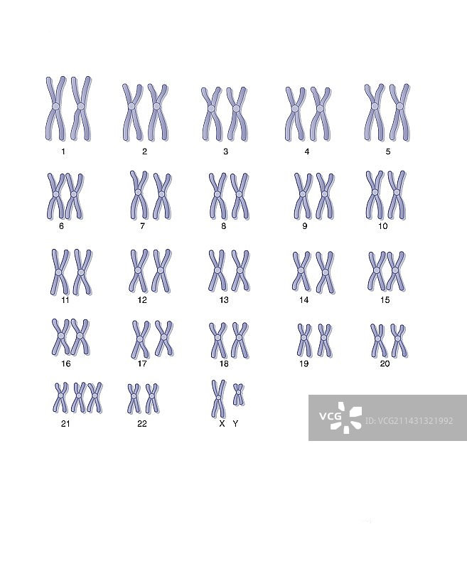 男性唐氏综合征核型图图片素材
