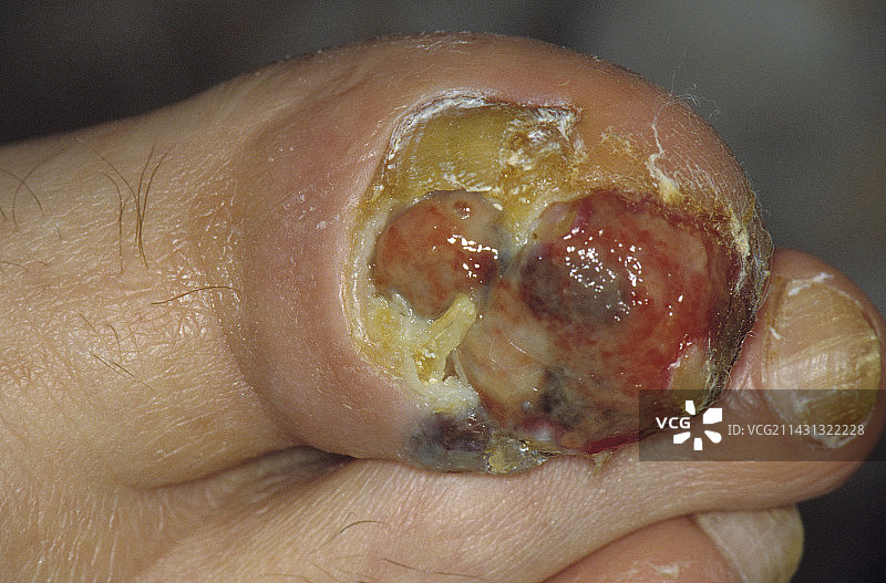 脚趾下的皮肤癌图片素材