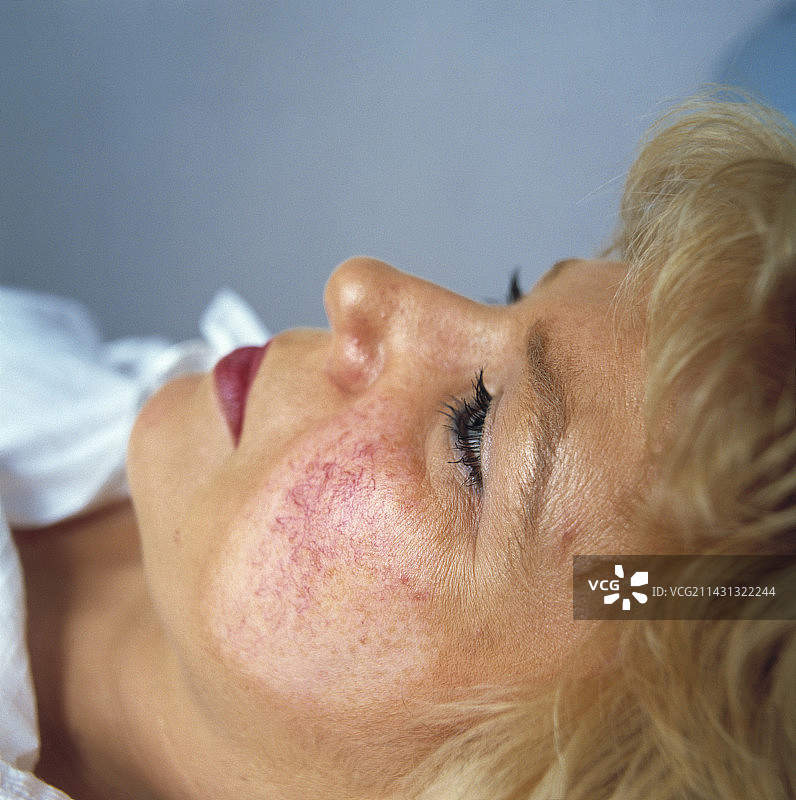 美容激光手术图片素材