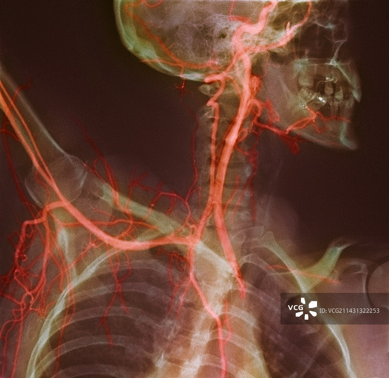 颈部和肩部动脉X光片图片素材