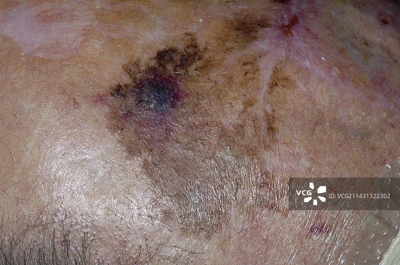 头皮上的恶性雀斑痣图片素材