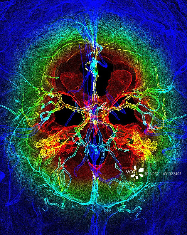 颅内动脉3D CT扫描图片素材