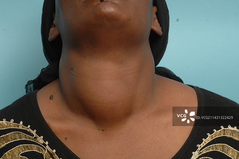 患有多发性结节性甲状腺肿的女人图片素材