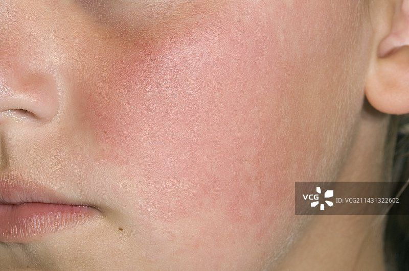 因病毒感染而发红的脸颊图片素材