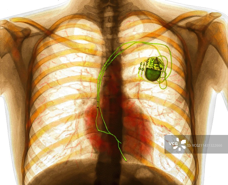 心脏起搏器胸部X光片图片素材