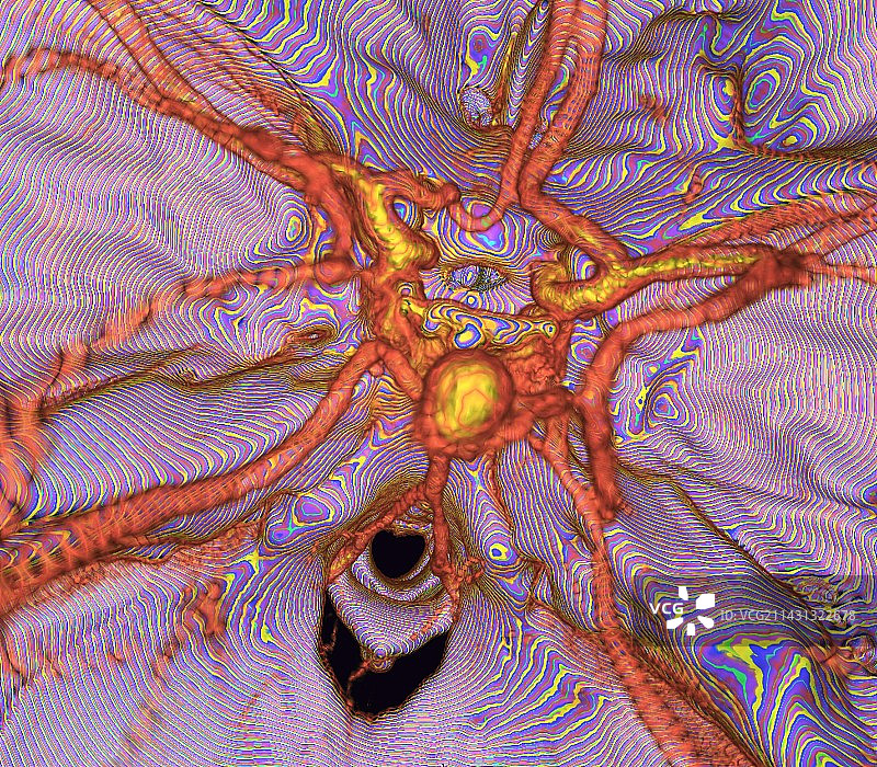 脑动脉瘤3D CT扫描图片素材