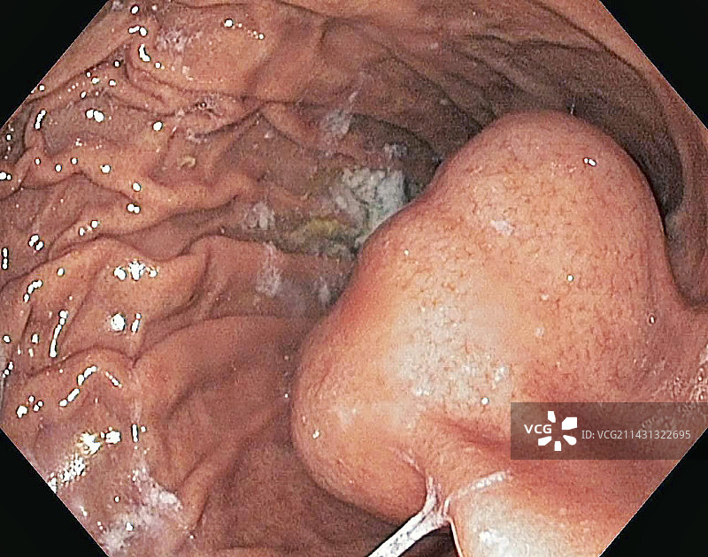 胃肠道间质瘤，内窥镜视图图片素材