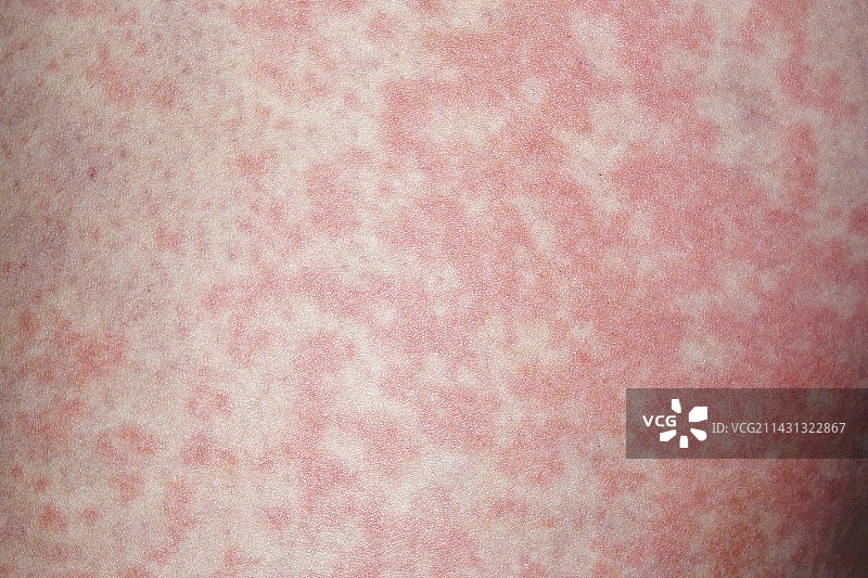 荨麻疹图片素材