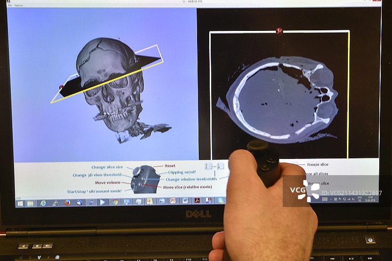 法医3D虚拟尸检图片素材