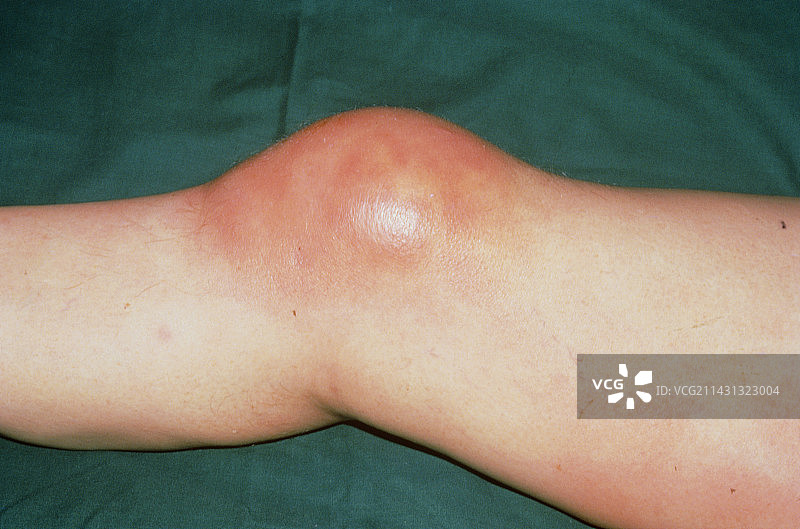 管家膝图片素材