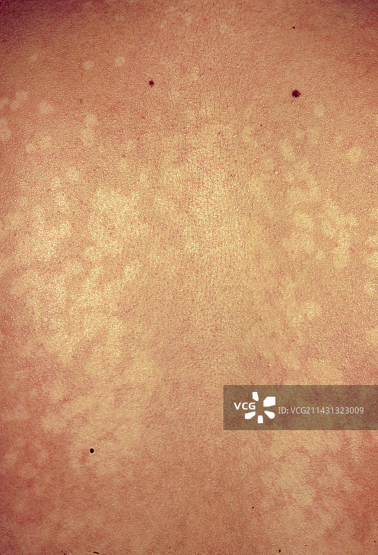 花斑癣导致皮肤出现浅色斑块图片素材